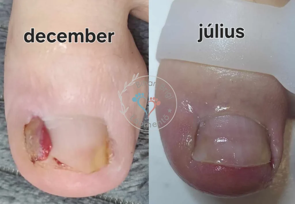 Benőtt, gyulladt köröm vadhússal – sarjszövet