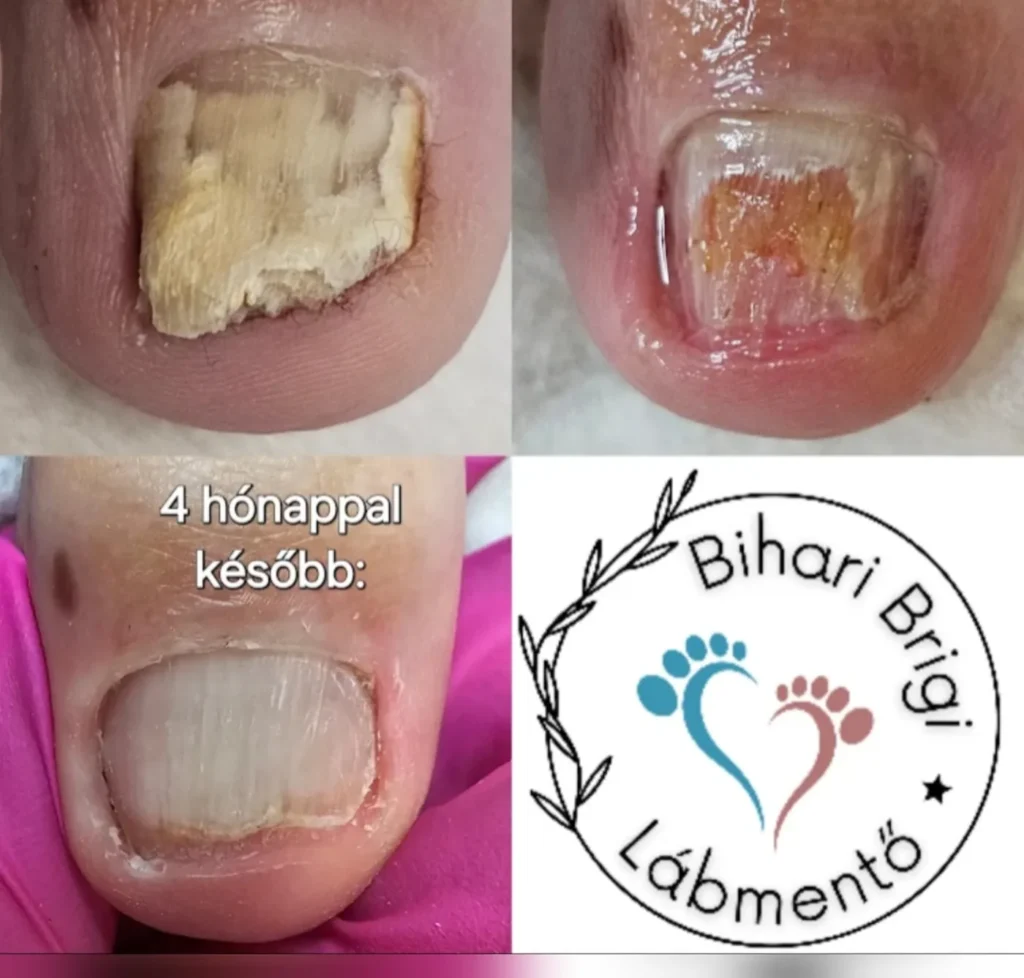 Gombás köröm – négy hónap alatt látható változás