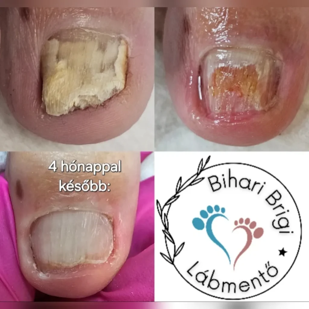 Gombás köröm négy hónap alatt változás